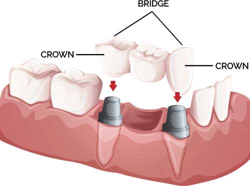 crown and bridges